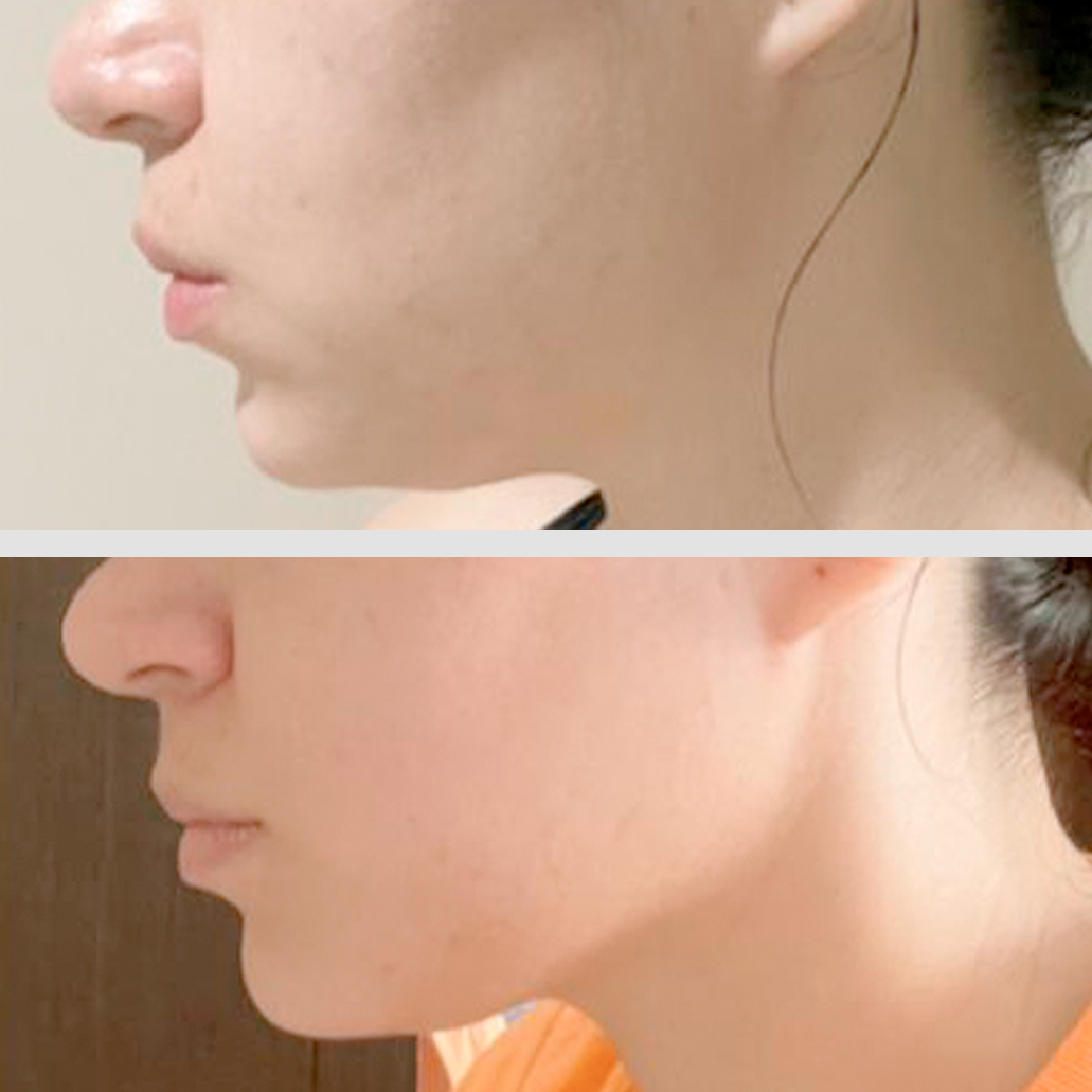 Gua Sha