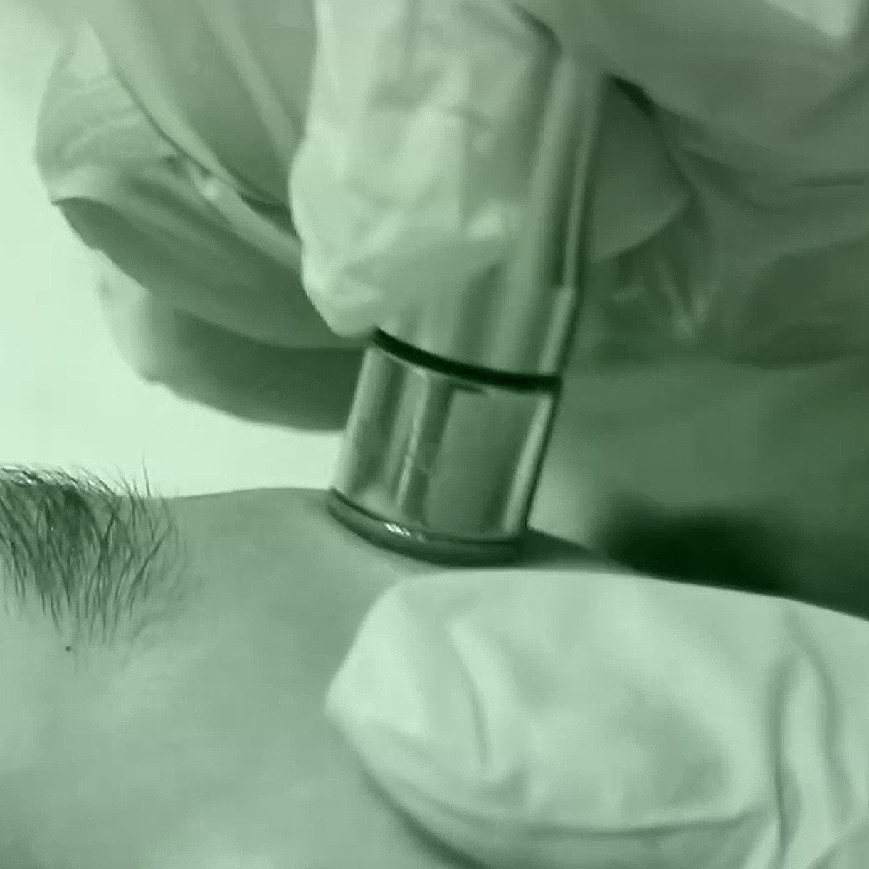 Microdermoabrasión Facial