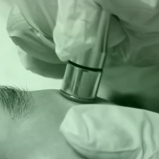 Microdermoabrasión Facial