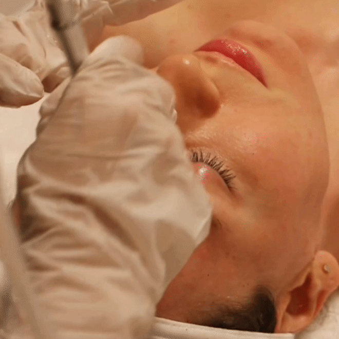 Microdermoabrasión Facial